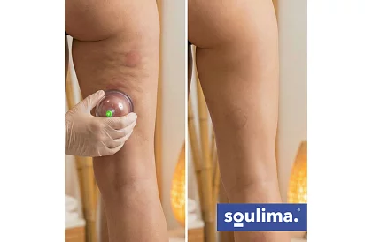 Sada čínskych baňiek na baňkovanie bez ohňa – 12 kusov